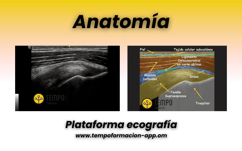 2. Tendon supraespinoso ecografia y patologia.png